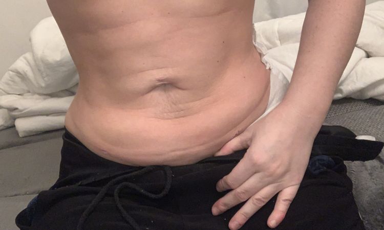 20 Tage nach fettabsaugung - 49987