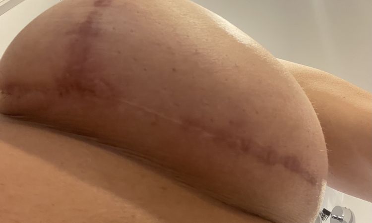 Narbenverlauf nach Brustverkleinerung Op - 50238
