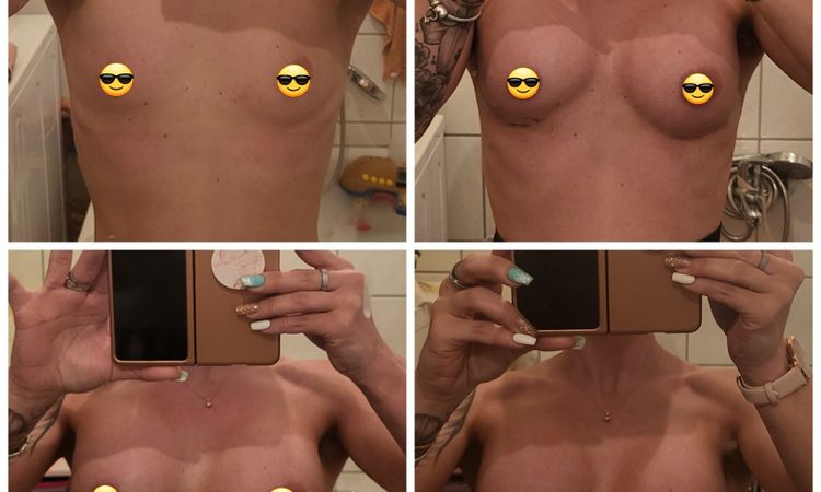 Asymmetrie nach Brustvergrößerung - 50267