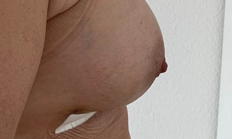 Kann das Implantat noch runter rutschen? - 50277