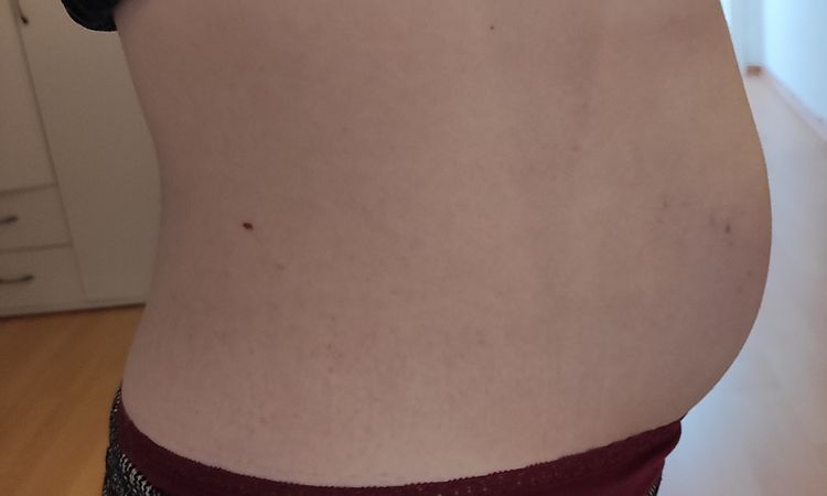 Fettabsaugung am Bauch bei mir möglich? - 50318
