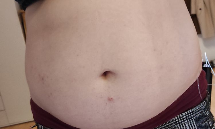 Fettabsaugung am Bauch bei mir möglich? - 50319