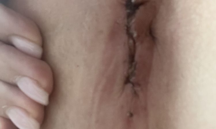 Brustvergrösserung - Narbe sieht komisch aus - 50341
