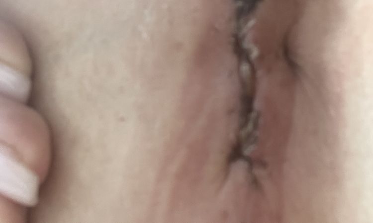 Brustvergrösserung - Narbe sieht komisch aus - 50342
