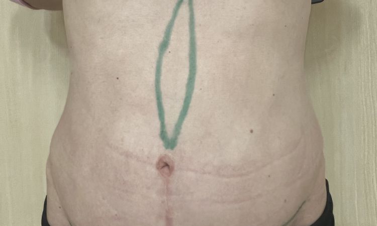 BDS OP gelungenes Ergebnis? - 50348