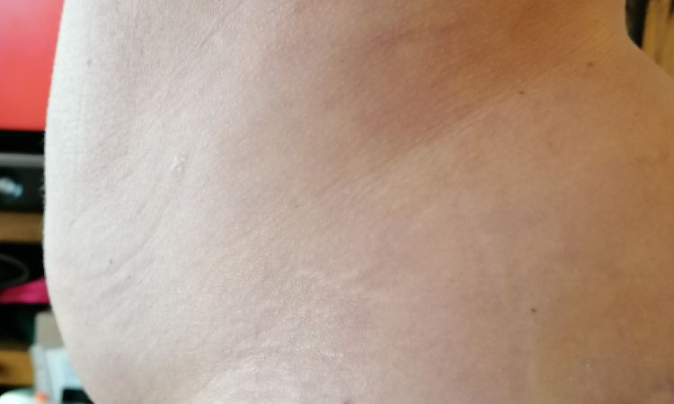 Wasseransammlung im Unterbauch nach Liposuction - 50491