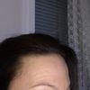 Augenbrauenfalten nach Botoxbehandlung der Stirn - 50661