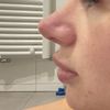 Knorpel in Nase wieder entfernen