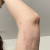 11 Monate nach Liposuktion Narben und Verhärtungen. Was kann ich tun? - 51010
