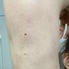 11 Monate nach Liposuktion Narben und Verhärtungen. Was kann ich tun? - 51012