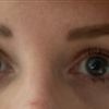Information über Endoskopisches Augenbrauenlifting