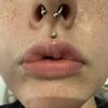 „Knubbel“ Narbe an der Lippe nach Operation in der Kindheit