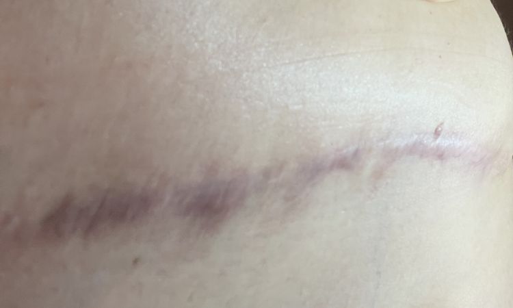 Narben 1 Jahr nach Bauchdeckenstraffung - 51154