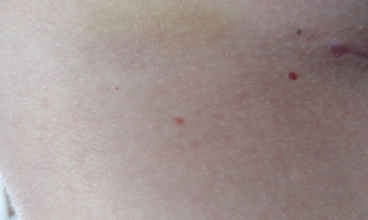 Brennende Schmerzen 5 Wochen nach Brustvergrößerung - 51175