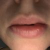 Verformte Unterlippe(Kapsel) nach Lippenunterspritzung mit Silikonöl