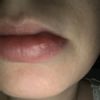 Verformte Unterlippe(Kapsel) nach Lippenunterspritzung mit Silikonöl