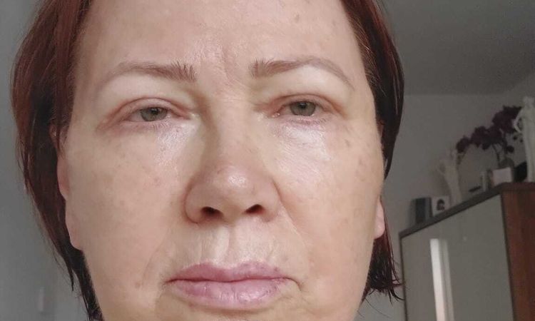 Hängende Lippe nach Facelifting - 51222