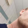Narbenkorrektur einer verbreiterten Narbe