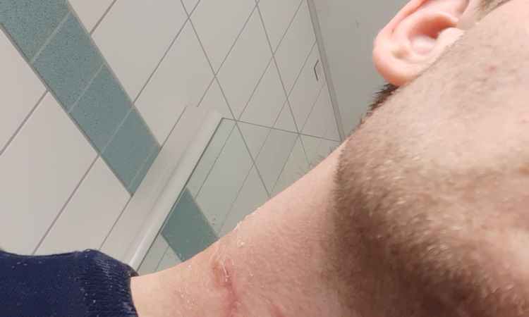 Narbenkorrektur einer verbreiterten Narbe - 51282