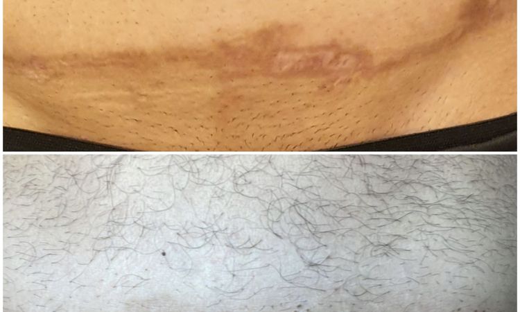 Auffälige Narbe nach Bauchdeckenstraffung - 51309
