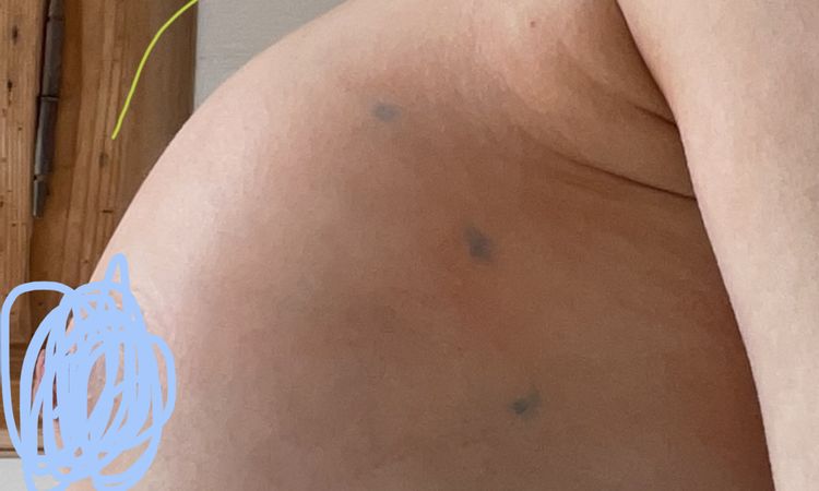 Beule auf der linken Brust. Was kann man tun? - 51334