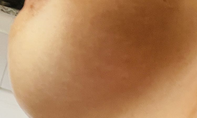 Double Bubble nach Brustvergrößerung? - 51338