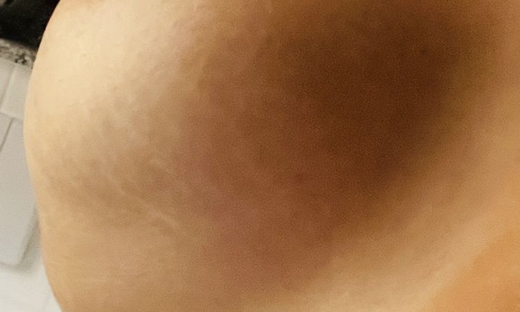 Double Bubble nach Brustvergrößerung? - 51339