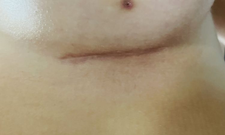 Double Bubble nach Brustvergrößerung? - 51342