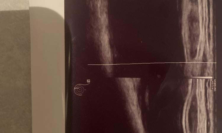 Ruptur Brust - Implantatwechsel notwendig? - 51417