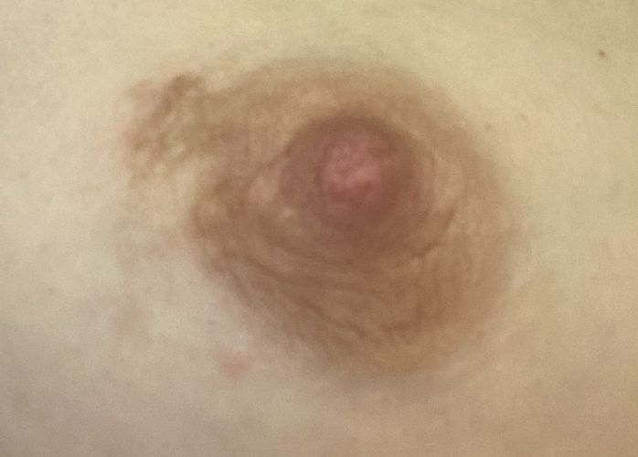 Postinflammatorische Hyperpigmentierung