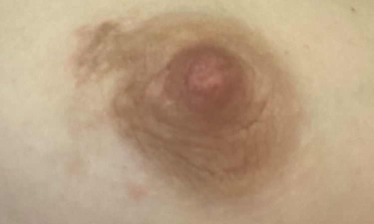 Postinflammatorische Hyperpigmentierung - 51577