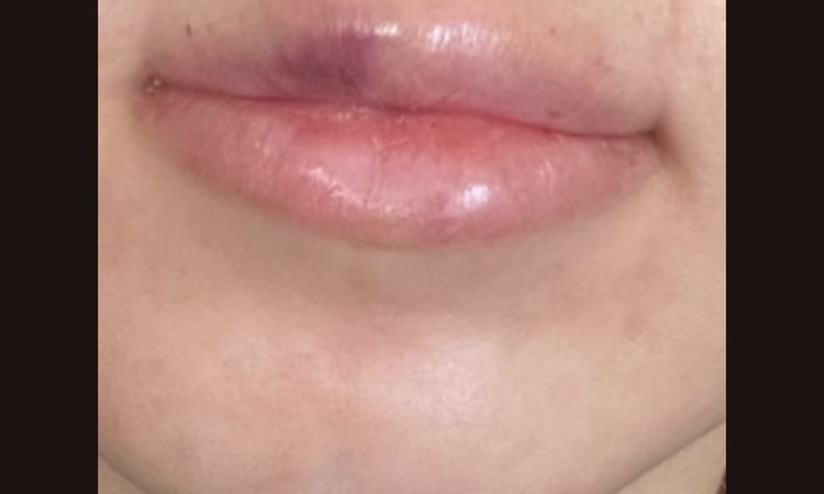 Hämatom nach Lippenunterspritzung? - 51740