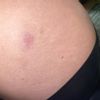 Rote Stelle nach BBL