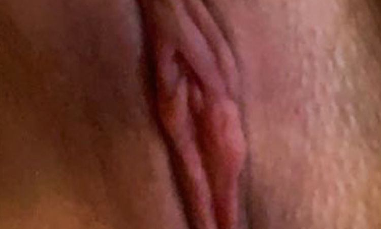 Wie könnte Korrektur von assym. Schamlippen (nach Verkleinerung) aussehen? - 52112