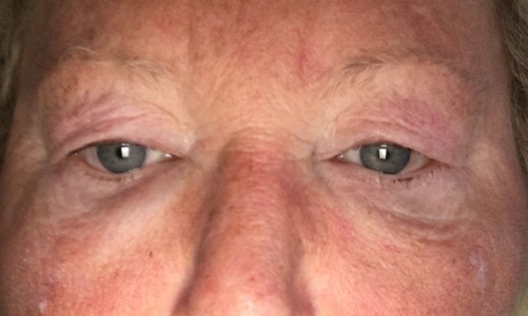 Gesicht geschwollen nach Botox & Hyaluron - 52227