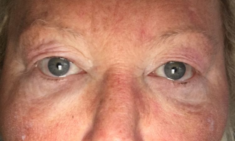 Gesicht geschwollen nach Botox & Hyaluron - 52228