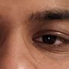 Behandlung bei müden und angeschwollenen Augenlidern - 22 Jahre männlich - 52440