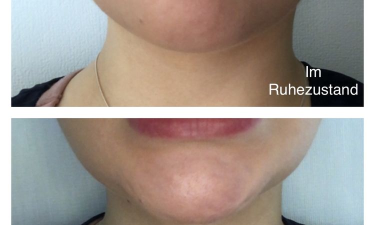 Kinn bei dynamischer Kinnptosis mit Botox behandeln? - 52579