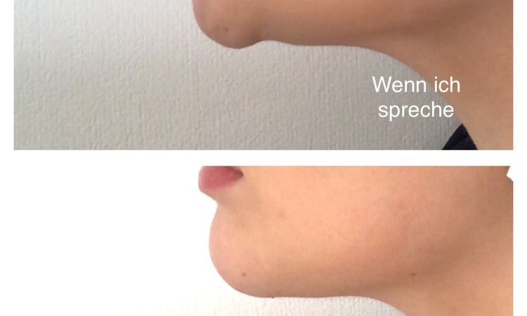 Kinn bei dynamischer Kinnptosis mit Botox behandeln? - 52580