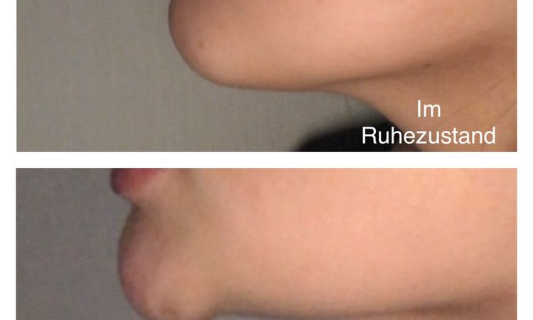 Kinn bei dynamischer Kinnptosis mit Botox behandeln? - 52581