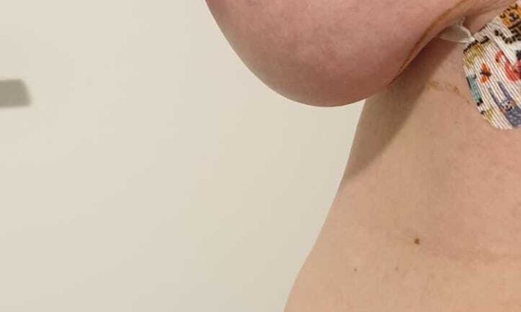 Hängebrust nach Implantatwechsel - 52604