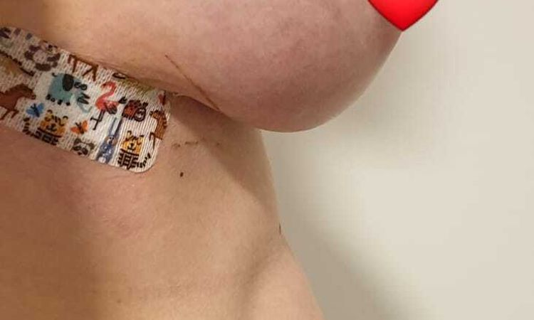 Hängebrust nach Implantatwechsel - 52605