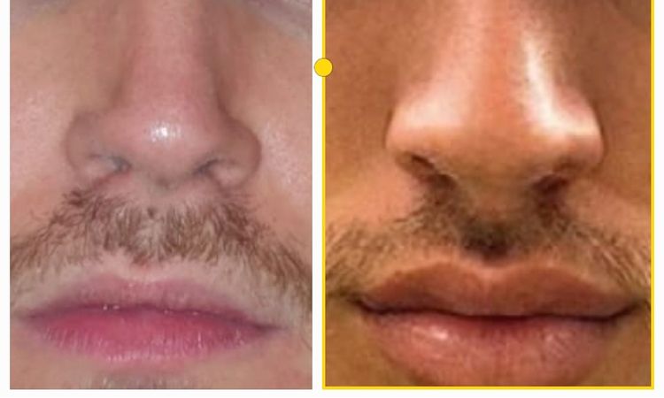 Ich möchte gerne meine Lippe formen- welche Behandlung sinnvoll? - 52667