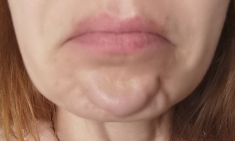 Botox im Kinn wirkt nur halb - 52718