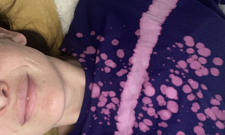 Hyaloron nach 1,5 Jahren noch immer sichtbar - 52725