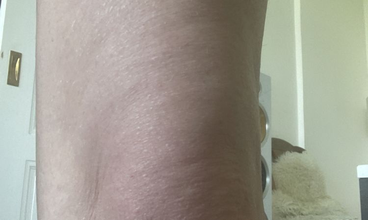 Was hilft am besten gegen schlaffe Haut an Knie? - 52834
