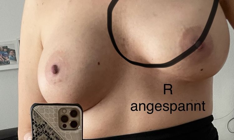 1 Jahr nach Brustvergrösserung: Brüste weit auseinander - 52847
