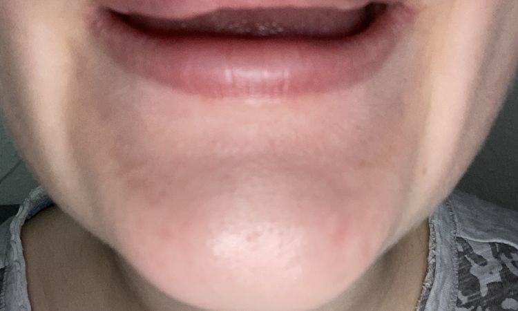 Unklarheiten bzgl. Ergebnis Lippen aufspritzen - 53097