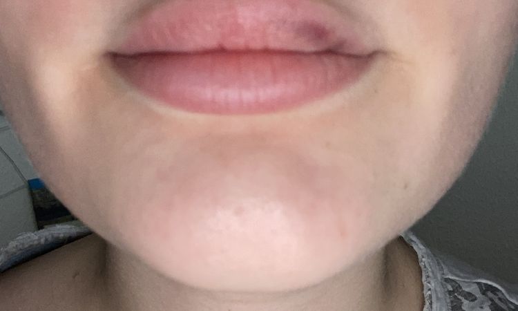 Unklarheiten bzgl. Ergebnis Lippen aufspritzen - 53098