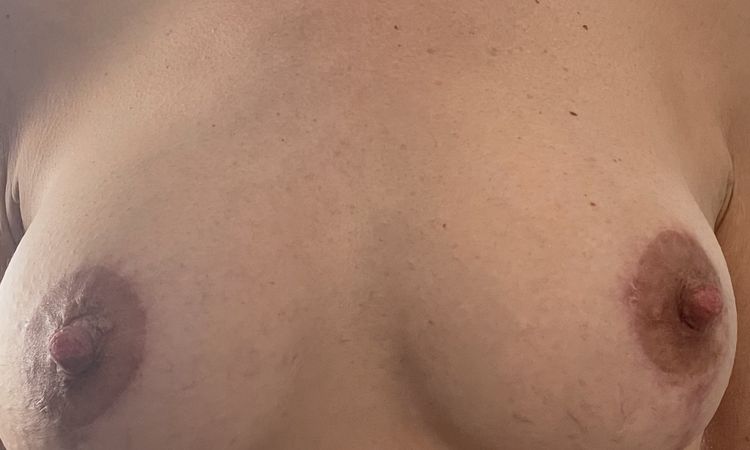 Anpassung der Brüste nach Brustvergrößerung - 53211